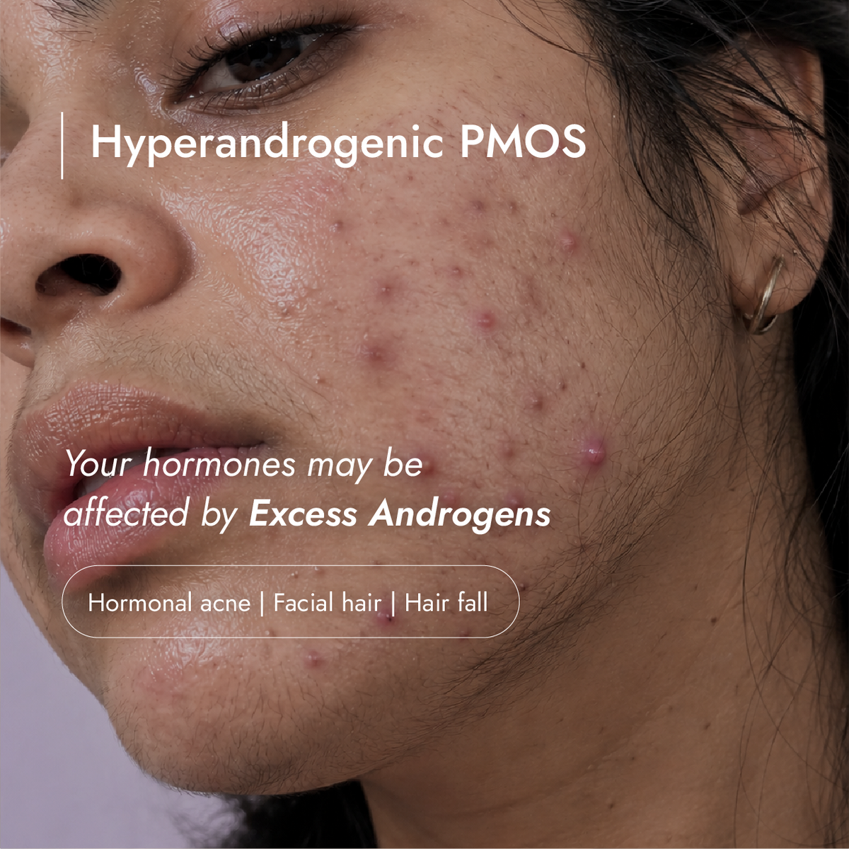 Hyperandrogenic PMOSolve Kit